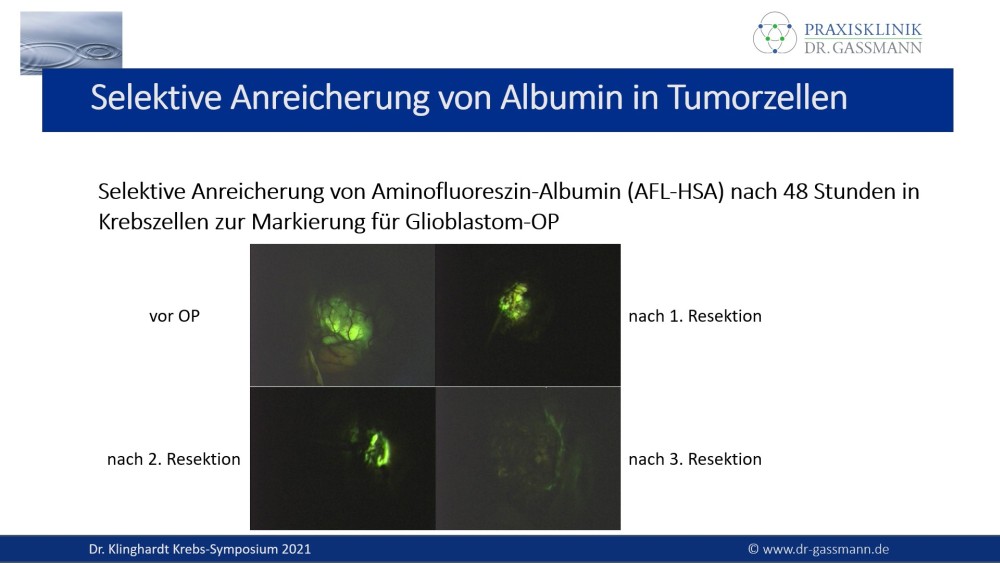 Selektive Anreicherung von Albumin in Tumorzellen: Aminofluoreszin-Albumin (AFL-HSA) nach 48 Stunden in Krebszellen zur Markierung für Gioblastom-OP